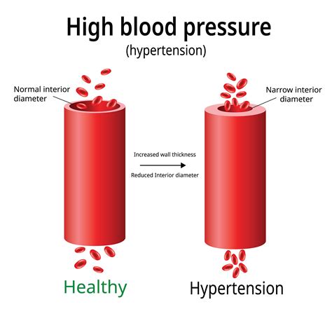 High Blood Pressure (Hypertension) Symptoms & Treatment | Dr Raghu
