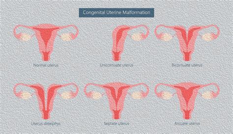 How Rare Is Septate Uterus