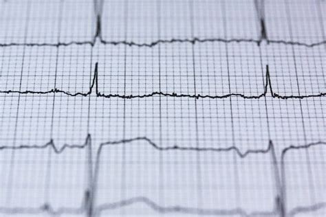 What is the difference between ECG and ECHO tests? – MyDiagnostics