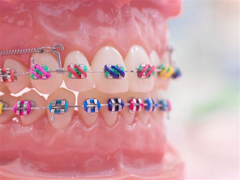 Different Types Of Braces Wire at Chloe Chauvel blog