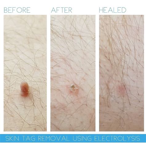 Skin Tag Removal Treatment in Middlewich, Cheshire