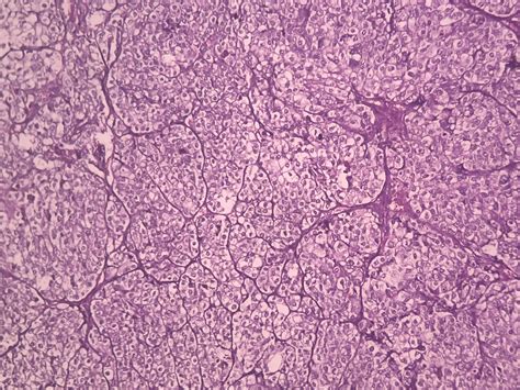 Clear Cell Adenocarcinoma Ovary