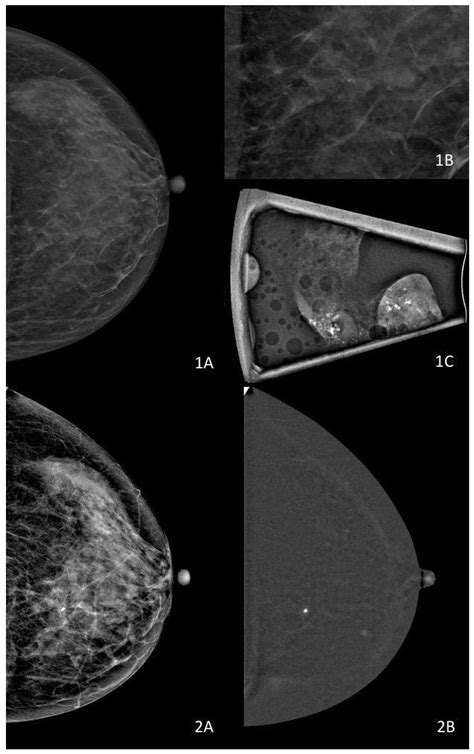 Imaging Ductal Carcinoma In Situ in the Era of De-Escalation: Role ...