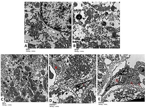 Hepatoprotective Role of Carvedilol against Ischemic Hepatitis ...