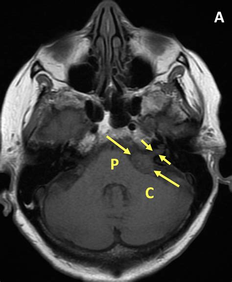 Vestibular Schwannoma - MRI Online / Medality
