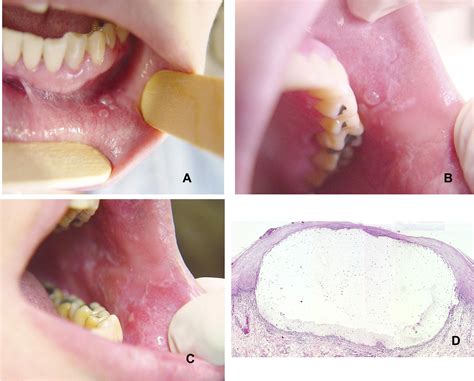 Oral Mucocele Burst at Benjamin Whitley blog