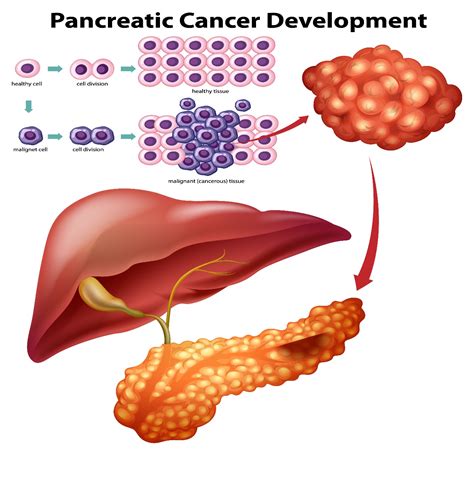 Understanding the Symptoms and Treatments to Pancreatic Cancer | Omega Hospitals