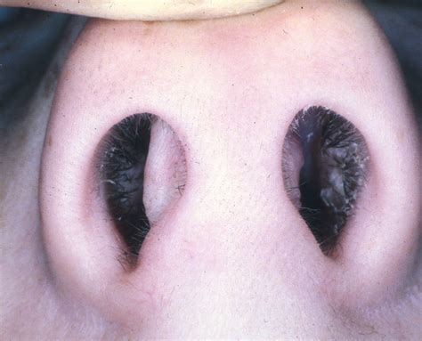 Nasal Septum Surgery - ENT Consultant - ENT Surgery - London - Essex