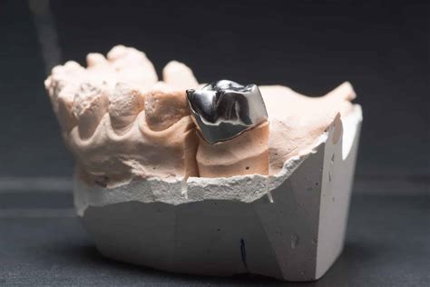 All About Metal Dental Crowns - Online Dental Care