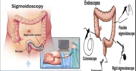 Rigid Sigmoidoscopy - Procedure, Cost and Benefits