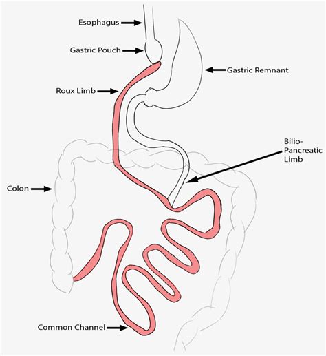 Roux-en-Y verse Loop Small Intestine Reconfiguration in Bariatric Surgery – Bariatric Surgery ...