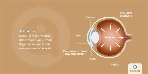 Glaukoma | Gejala, Diagnosis, Pengobatan