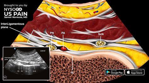 Pudendal Nerve Block Ischial Spine