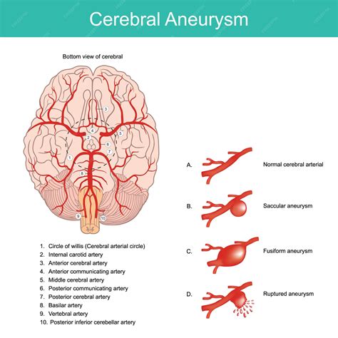 Cerebral aneurysm a bulging artery weakened area in the wall of an ...