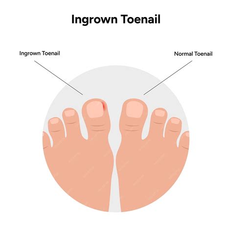 Premium Vector | Ingrown toenail disease or infection