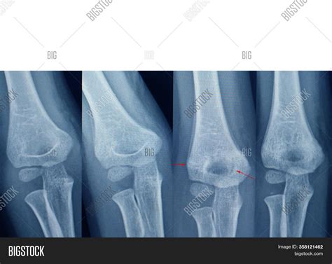 Nursemaid Elbow Xray