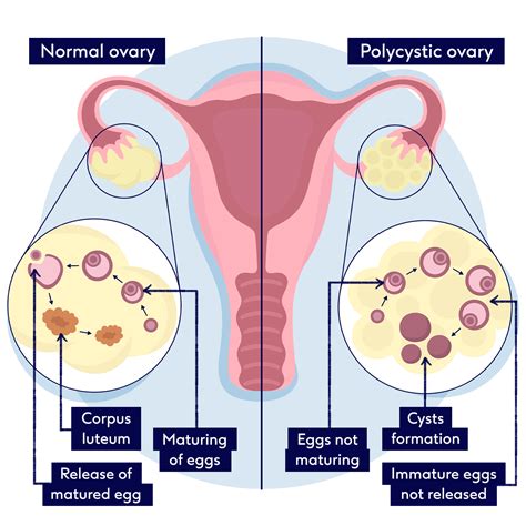 Polycystic In Spanish