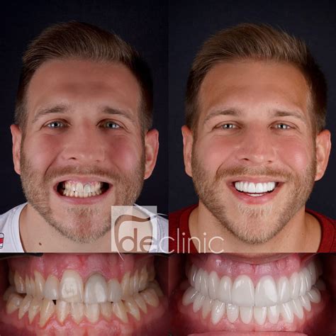Receding Gums Surgery