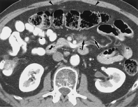 Disproportionate Fat Stranding: A Helpful CT Sign in Patients with ...