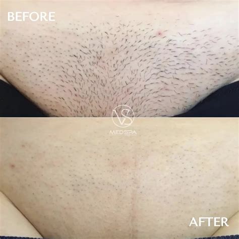 Laser Hair Removal Pubic Area