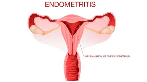 Can Endometriosis Cause Chemical Pregnancy? – NutritionFact.in