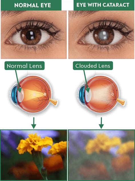 Know Everything About Best Treatment For Cataract FAQ’s – Global Eye ...