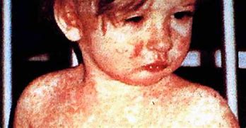 measles 的图像结果