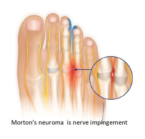 Ball of Foot Pain Running 的图像结果
