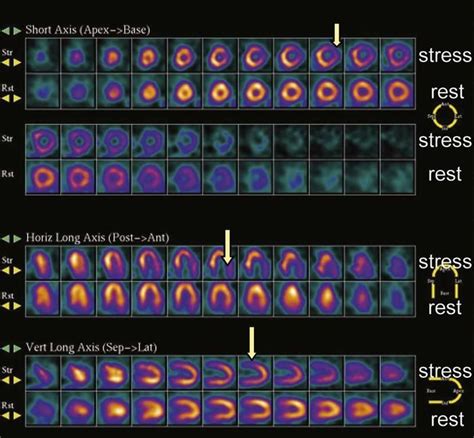 stress nuclear test