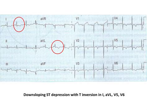 ECG Changes in Myocardial ischemia, myocardial infarction.pptx