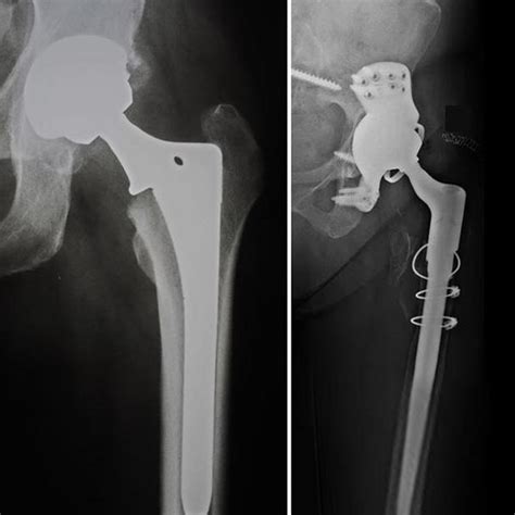 What are Revision Implants for second surgery? | Dr. Ramneek Mahajan