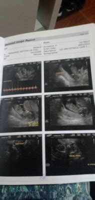 Sexo tn 13 semanas e 4 dias | BabyCenter
