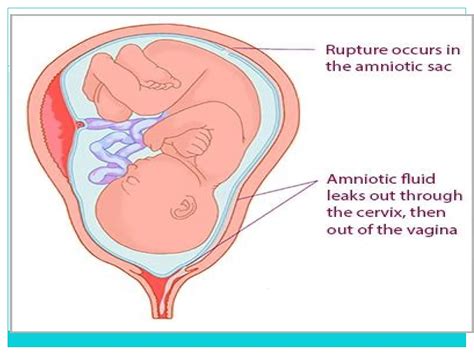 PREMATURE RUPTURE OF MEMBRANE(PROM) new.pptx
