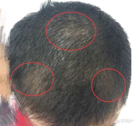 头发稀疏能植发吗？