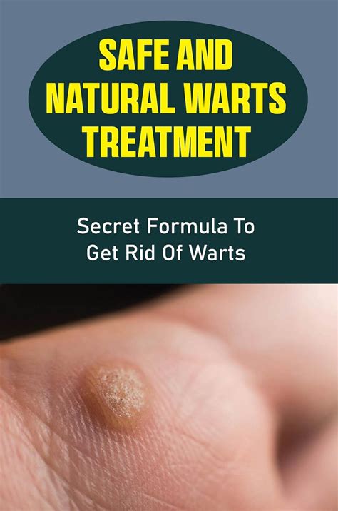 Safe And Natural Warts Treatment: Secret Formula To Get Rid Of Warts ...
