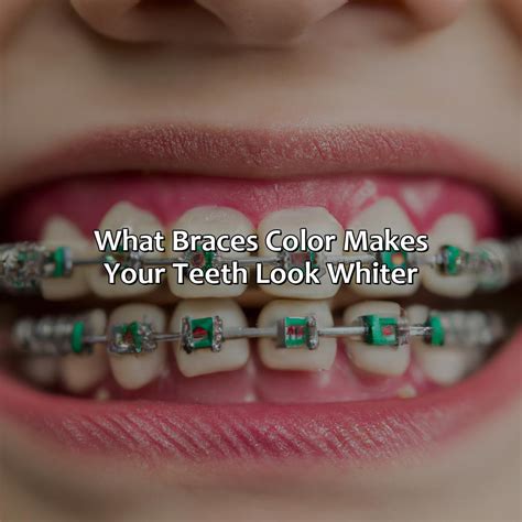 What Colors Make Your Teeth Look Yellow With Braces at Barbara Eley blog