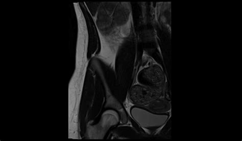 Image result for Normal Appendix MRI