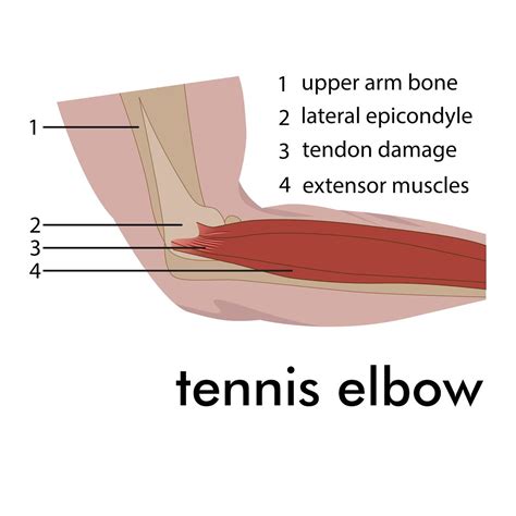 Tennis elbow treatment, What is it & how to cure it - Newcastle Physiotherapy