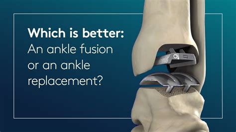 Which is better an ankle fusion or an ankle replacement? - YouTube