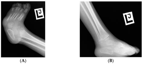 Caudal Regression Syndrome—A Narrative Review: An Orthopedic Point of View