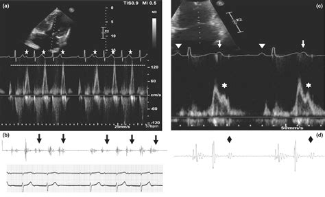 Early diastolic heart sounds caused by the atrial kick - Bachour - 2024 - Annals of Noninvasive ...