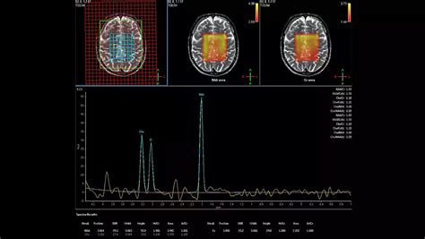 Philips - Spectroscopy - Brain MR Clinical application - Philips
