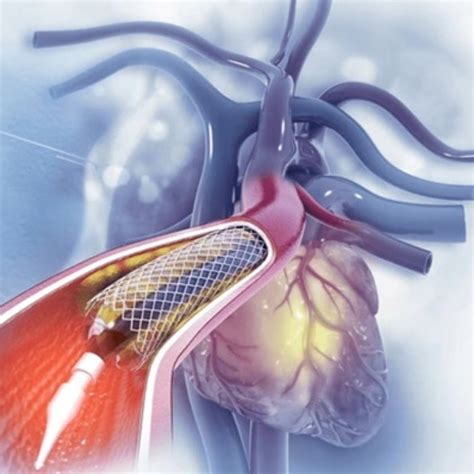 Top Angiography Doctors in Pune | Healthcare - Dr. Sunil Agarwal