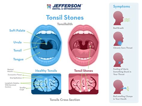 Tonsil Stones Cause