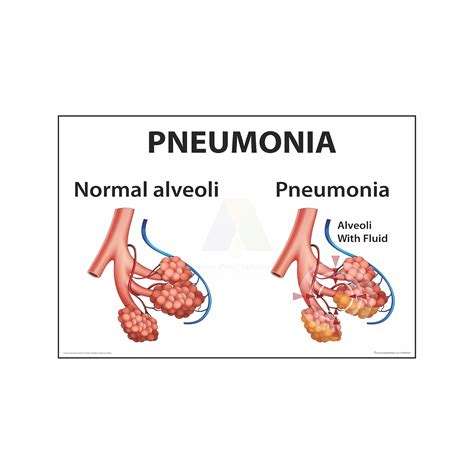 Anne Print Solutions® Pneumonia Chart Poster For Hospital Posters ...