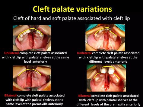 Cleft Palate & It's Management | PPTX