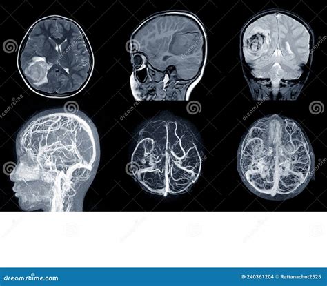 MRI of the BRAIN and MRA with MRV of the BRAIN IMPRESSION: a Large Acute Parenchymal Hemorrhage ...