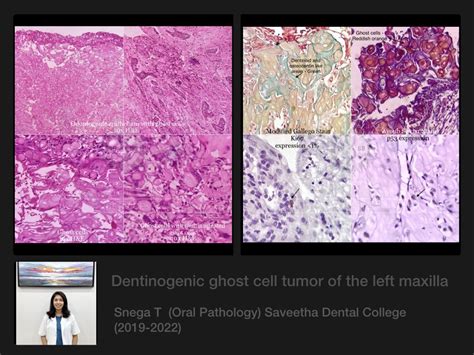 Dentinogenic Ghost Cell Tumor — ORAL PATHOLOGY-SAVEETHA