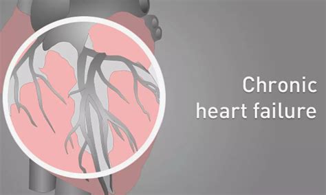 IV furosemide and metolazone lead to higher natriuresis in ambulatory ...