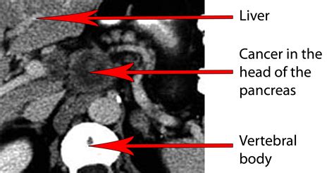 VirtualMedStudent.com || Pancreatic Adenocarcinoma